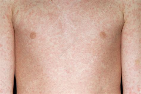 Measles Rash Stock Image M2100364 Science Photo Library
