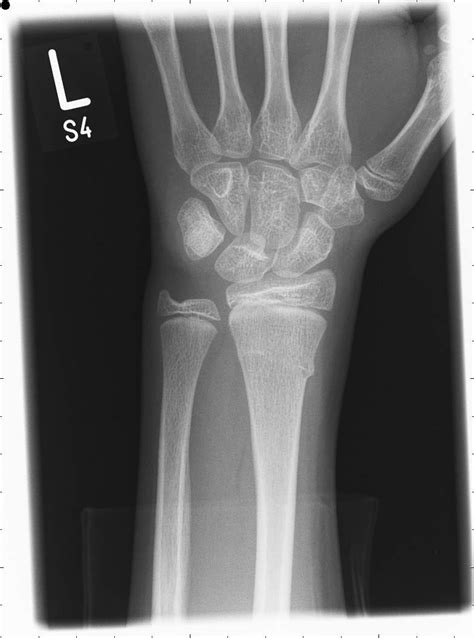 Posterior Anterior Pa And Lateral Radiographic Images Of The Left Wrist