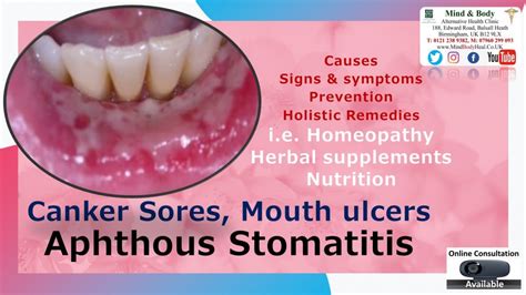Canker Sores Aphthous Stomatitis Mouth Ulcers Mind And Body Holistic Health Clinic