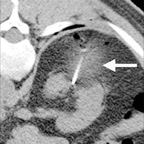 Percutaneous Cryoablation Of A Renal Mass Under Ct Guidance Note The
