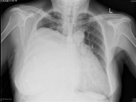 Chest X Ray A Large Tumorous Process Of The Right Hemithorax With