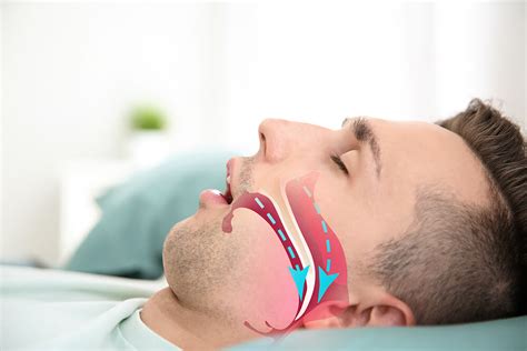 What Is Sleep Apnea Asia Pacific Dental Sleep Medicine