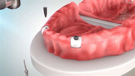 Proteza Dentara Pe Implanturi Youtube
