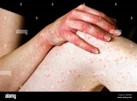 What Does A Penicillin Allergy Rash Look Like