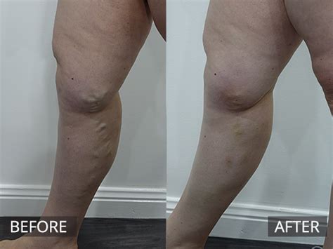 Varicose Veins Melbourne The Doc Cosmetic And Skin Clinic Melbourne