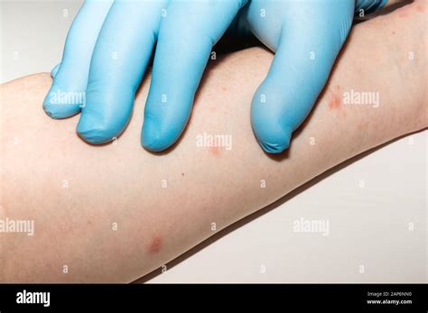 La Dermatite Atopique Banque De Photographies Et Dimages Haute