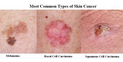 Skin Cancer Know The Facts Aspire Hospital