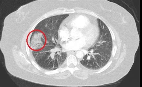 A Computed Tomography Angiogram Cta Of The Chest In A Lung Window