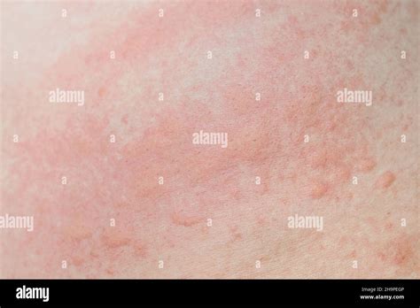 Eruzione Cutanea Allergica Calore Cutaneo Prurito Rosso Puntino Closeup