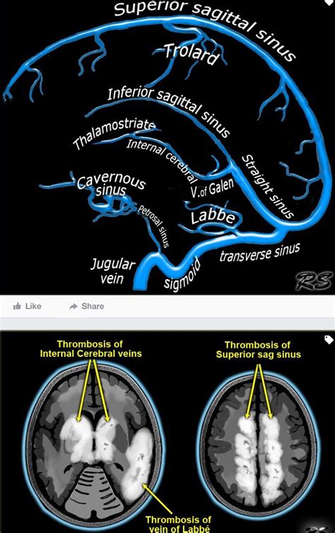 Anatomy Of Cerebral Veins And Sinuses Studykorner Radiology