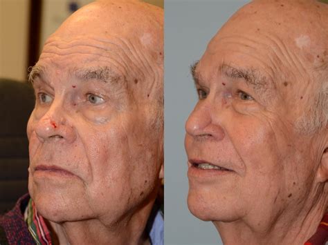 Forehead Flap Reconstruction Of Nasal Tip Following Mohs