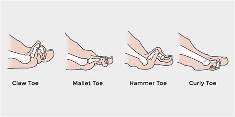 When a person has hammer toe, the end of their toe bends downward and the middle joint curls up. Crooked Toes - The Complete Injury Guide - Vive Health