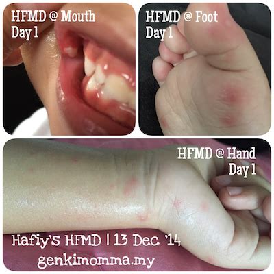 Elakkan menyentuh mata, hidung dan mulut dengan tangan yang tidak dicuci. Pengalaman Jaga Anak HFMD Rawatan Penyakit Tangan Kaki Dan ...