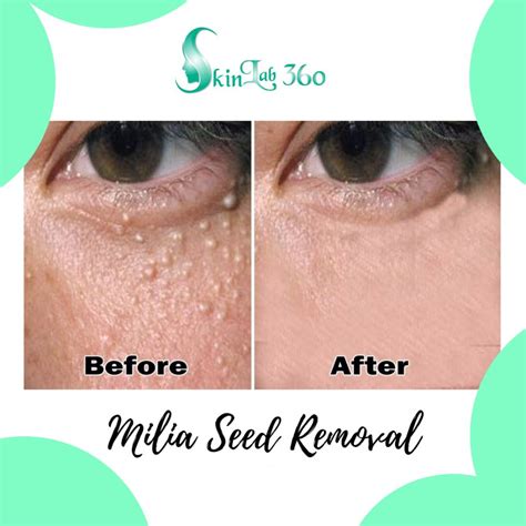 Milia Seed Skin Tag Removal Skin Lab