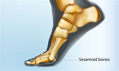 How To Deal With Issues With The Sesamoid Bone In The Foot