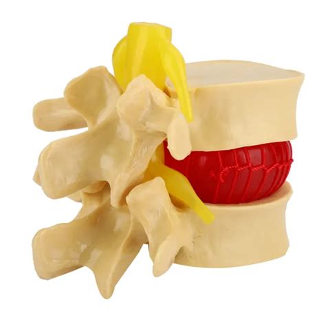Spine Model Lumbar Disc Herniation Demonstration Model Study