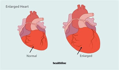 How To Treat An Enlarged Heart Can Natural Remedies Help