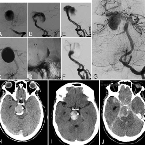 Images Obtained In A 66 Year Old Woman With A Giant Symptomatic