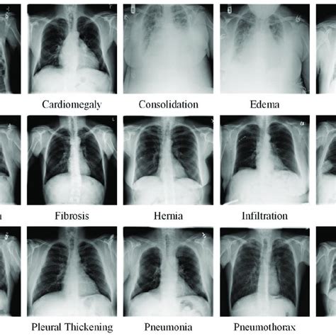 PDF Fusion High Resolution Network For Diagnosing ChestX Ray Images