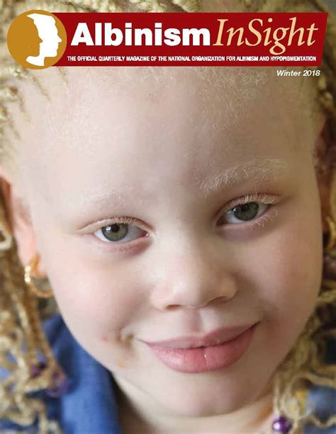 Albinism Insight National Organization For Albinism And Hypopigmentation