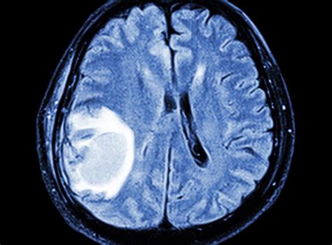 Brain Tumours Effectively Treated By Injecting Patients With Viruses