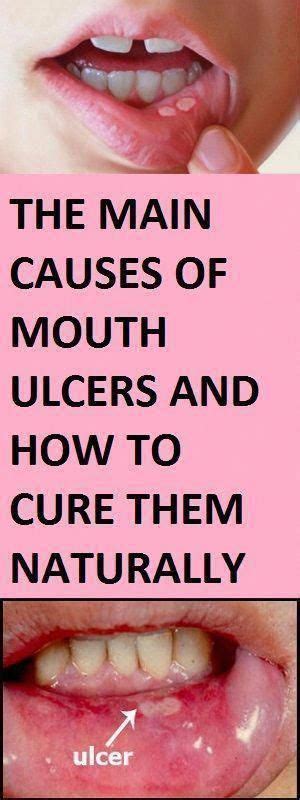 Mouth Ulcers Also Known As Canker Sores Are A Common Issue Which Is