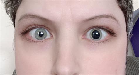 Potential Reasons For A Single Dilated Pupil I Have Sought Medical