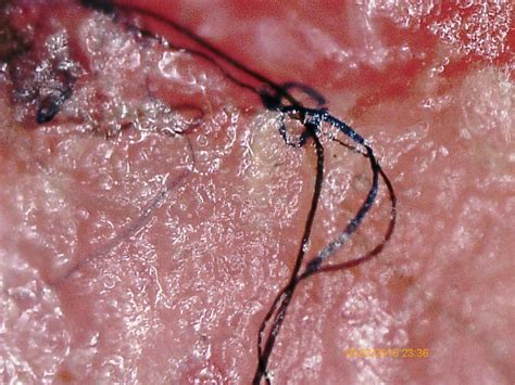 February Morgellons Disease Awareness Month What Is