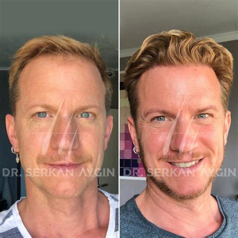 Hair Transplant In Turkey Before And After A Detailed Overview