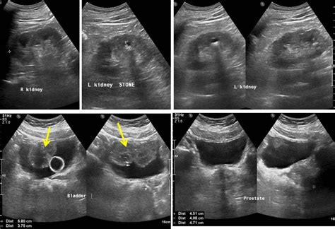Synchronous Urinary Bladder And Prostate Cancer Radiology Cases