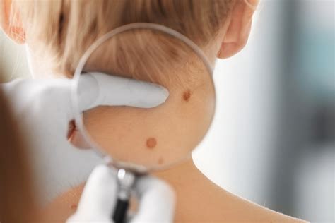 Birthmark Types Moles Macular Stains Port Wine Stains And More