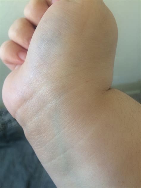 Ganglion Cyst I Found This Bump On My Wrist A While Back My Wrist