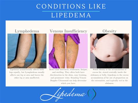Everything You Need To Know About Lipedema Treatment Lipedema