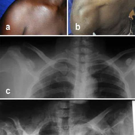 Floating Clavicles A And B Clinical Presentations Showing A