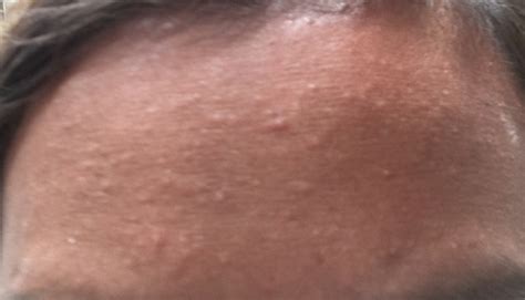 Small Bumps On Forehead General Acne Discussion By
