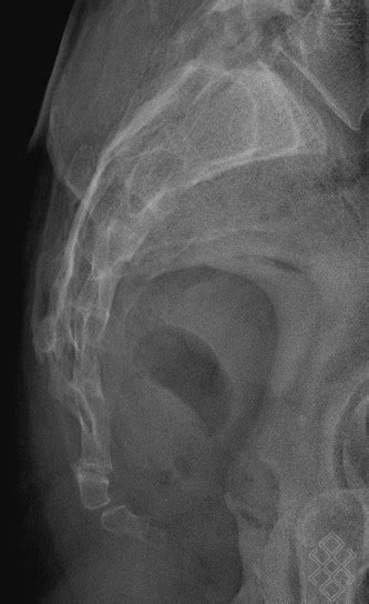 Radiographie Du Coccyx Définition And Déroulement Prise De Rdv En Ligne