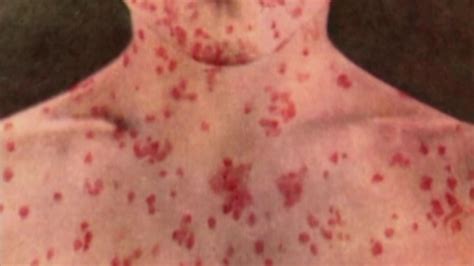 15th Measles Case In Illinois Confirmed In Suburban Cook County Abc7