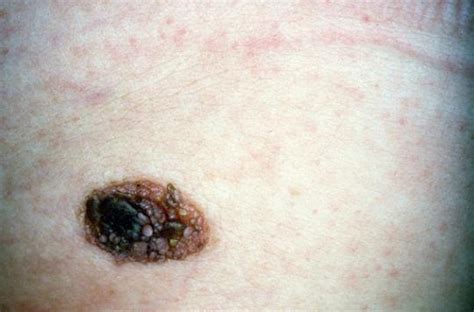 Melanoma Counting Moles On The Arm To Assess The Risks Ace Mind