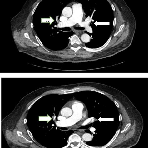 Series Of Ct Scan Images With Iv Contrast Indicating Bilateral Filling