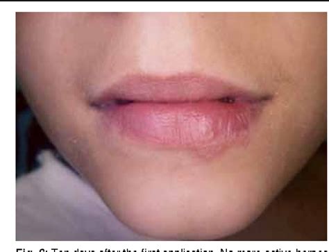 Pdf Recurrent Labial Herpes Simplex In Pediatric Dentistry Low Level