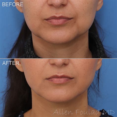 Neck Chin And Face Liposuction Beverly Hills Los Angeles