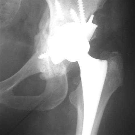Radiography Shows A Failure Of The Acetabular Component With Protrusion