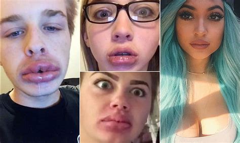 Kylie Jenner Challenge Sees Teens Suck Shot Glasses To Blow Up Their Lips Daily Mail Online