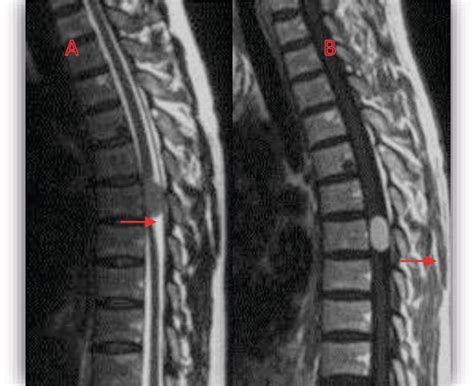 Surgical Treatment Of Benign Spinal Cord Tumors Intechopen