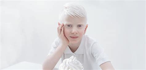 Albinizm Objawy