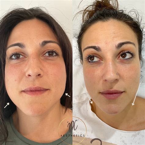 Facial Slimming Anti Wrinkle Injections Gold Coast Dc Aesthetics