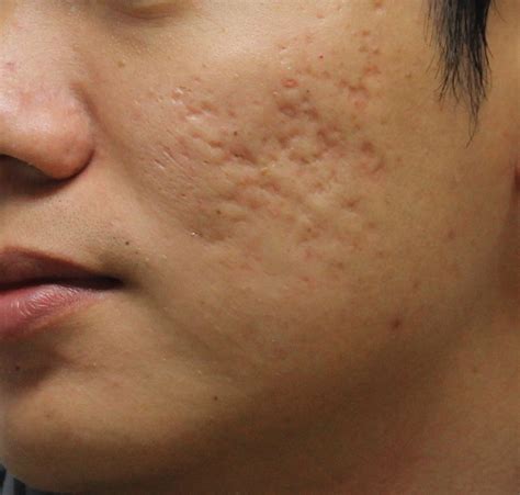 4 Easy Methods To Clear Up Acne Scars Blog De Fashion