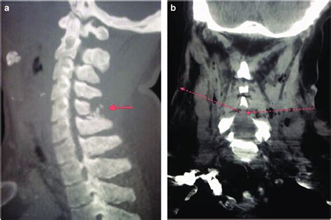 Cervical Spine Ct Scan A Longitudinal View Comminuted Fracture Of