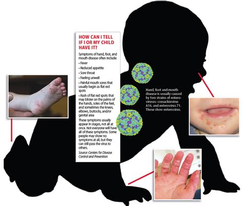 Hand Foot And Mouth Disease On Tongue