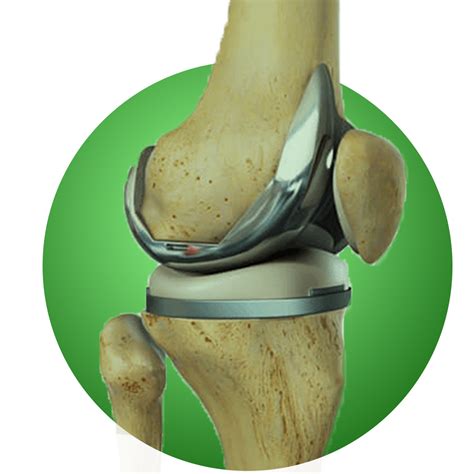 Knee Replacement Surgery At St Theresas Hospital Expert Care
